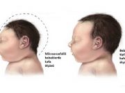 Zika virüsü ve küçük kafalılık bağlantısı