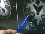 Uçuk deyip geçmeyin! Alzheimer ile uçuk virüsü arasında olası bir bağlantı mı?
